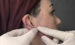 Muş’ta Ödüllü Yöntemle Zorlu Kulak Keloidi Ameliyatı