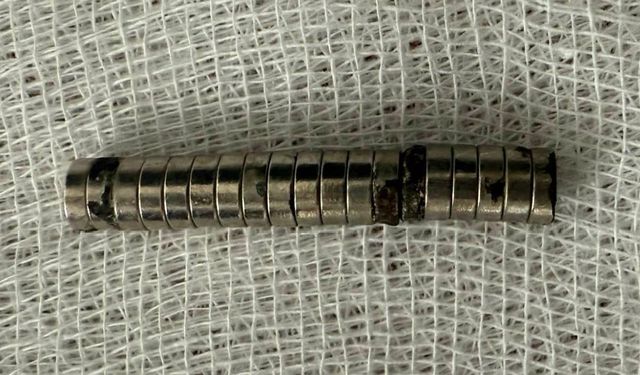 Erzurum'dan Elazığ'a Sevkedildi: Boğazından 19 Mıknatıs Çıkarıldı!