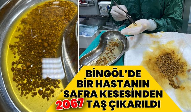 Bingöl’de Bir Hastanın Safra Kesesinden 2067 Taş Çıkarıldı