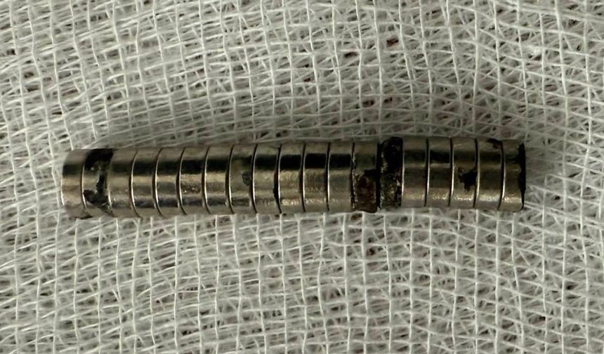 Erzurum'dan Elazığ'a Sevkedildi: Boğazından 19 Mıknatıs Çıkarıldı!