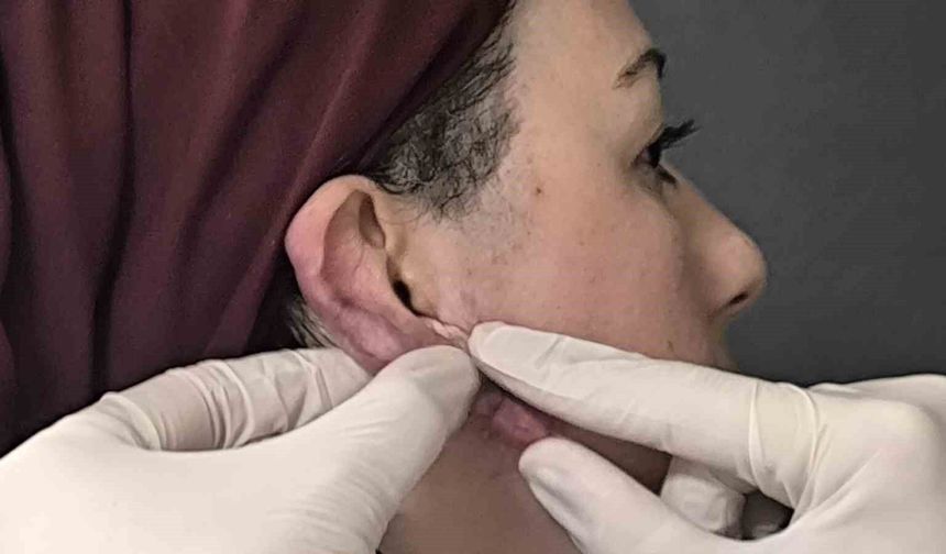 Muş’ta Ödüllü Yöntemle Zorlu Kulak Keloidi Ameliyatı